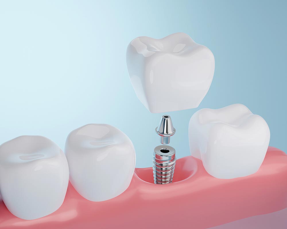Dental Implants Kalamunda