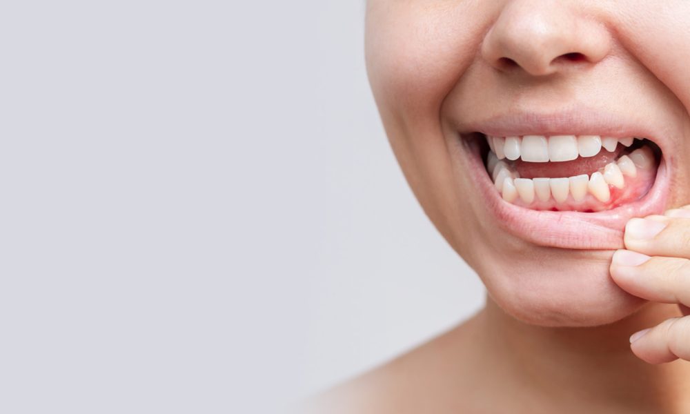 gum-disease-treatment