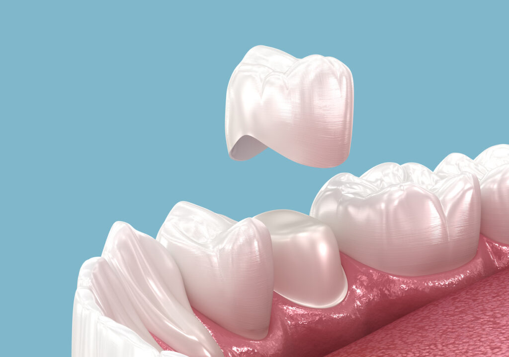 Dental Crown Services | Smile Square